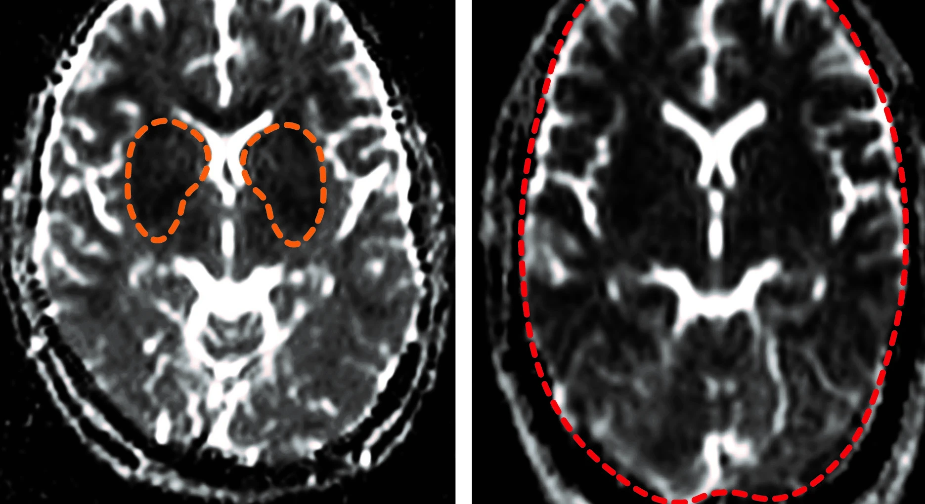 Study links severe malaria to long-term cognitive deficits in children