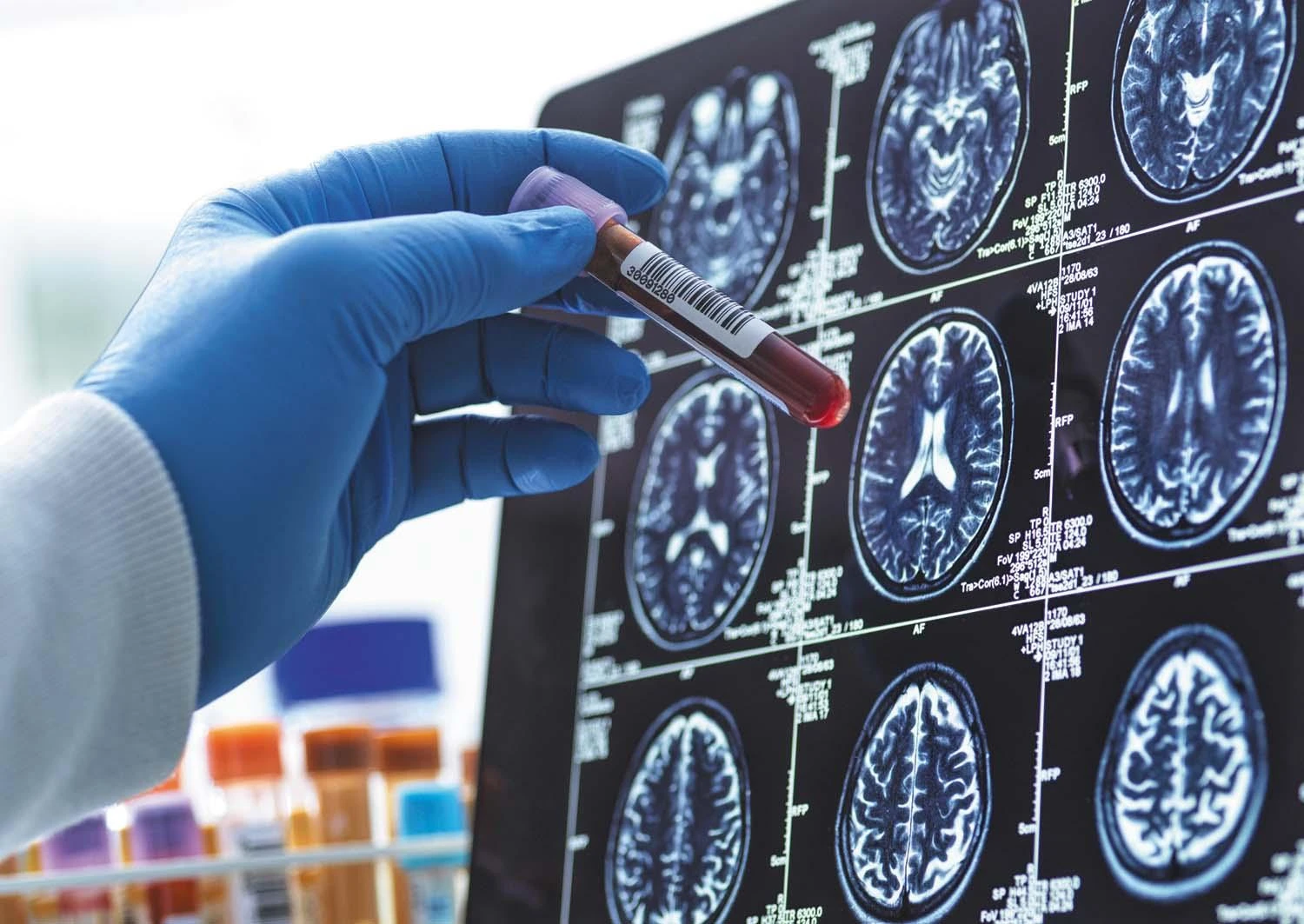New Blood Test Simplifies Alzheimer’s Detection Process